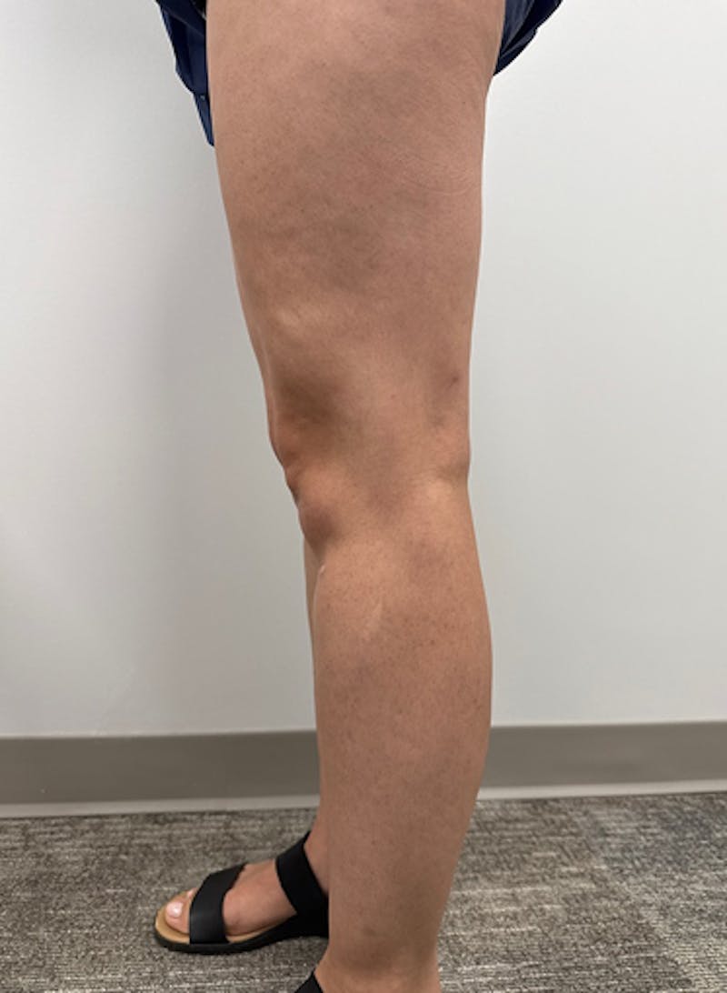 Varithena Treatment Before & After Gallery - Patient 128046 - Image 3
