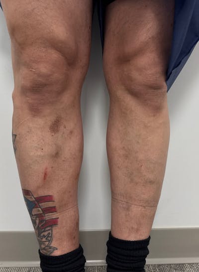 Varithena Treatment Before & After Gallery - Patient 325442 - Image 1