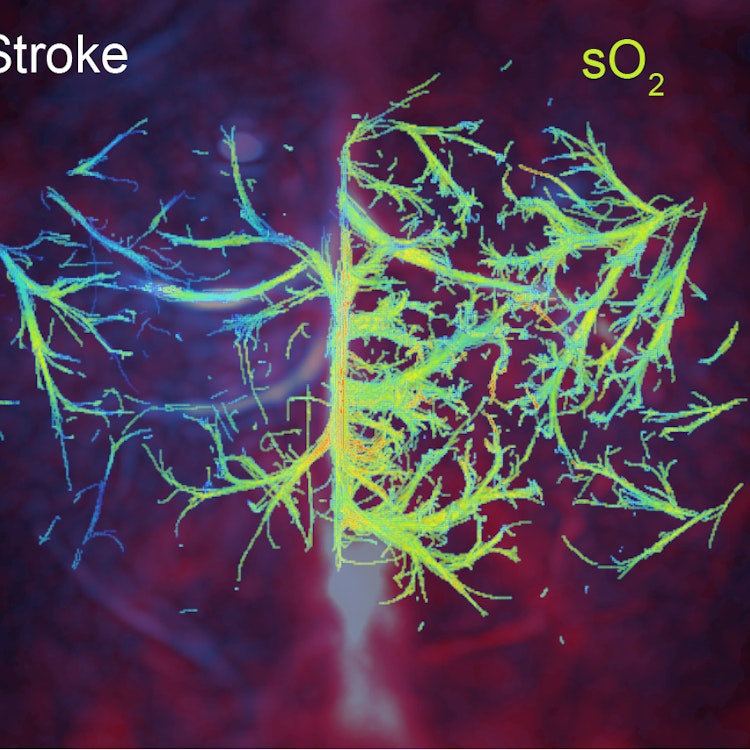 stroke
