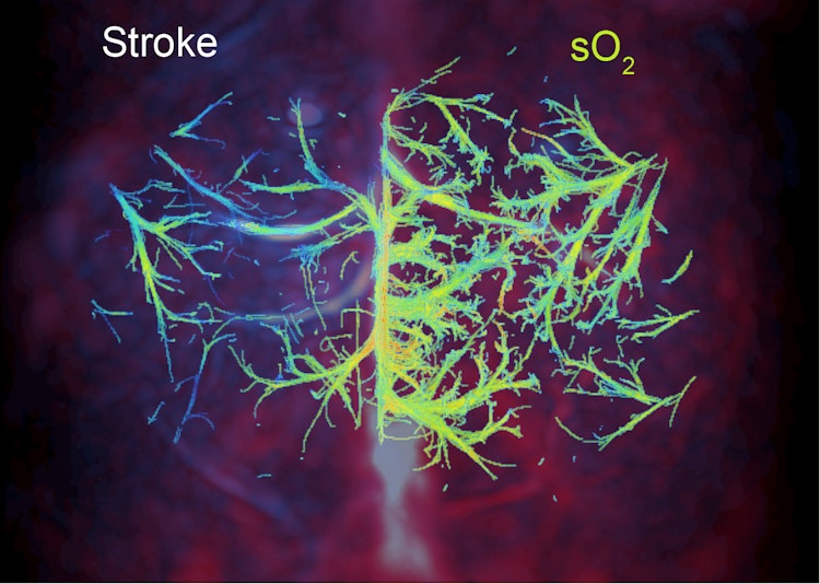 stroke