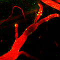 neutrophils-stroke