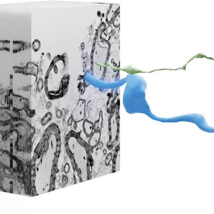 neuromyelitis optica