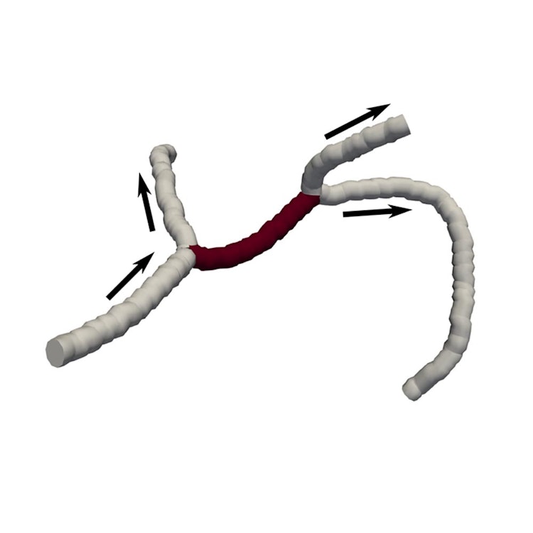 microstroke