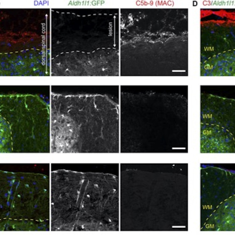 neuromyelitis optica