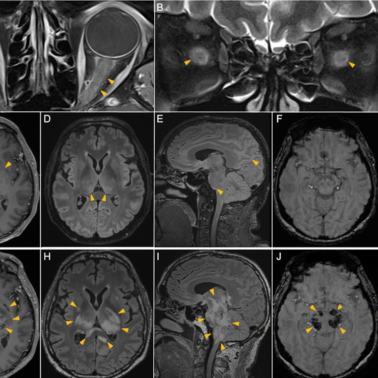 Acute haemorrhagic leucoencephalitis