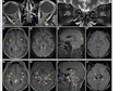 Acute haemorrhagic leucoencephalitis