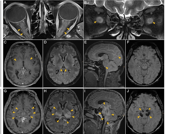Acute haemorrhagic leucoencephalitis