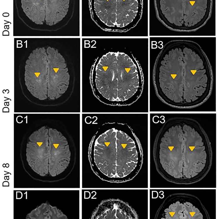 leukoencephalopathy