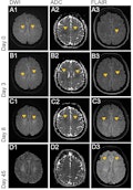 leukoencephalopathy
