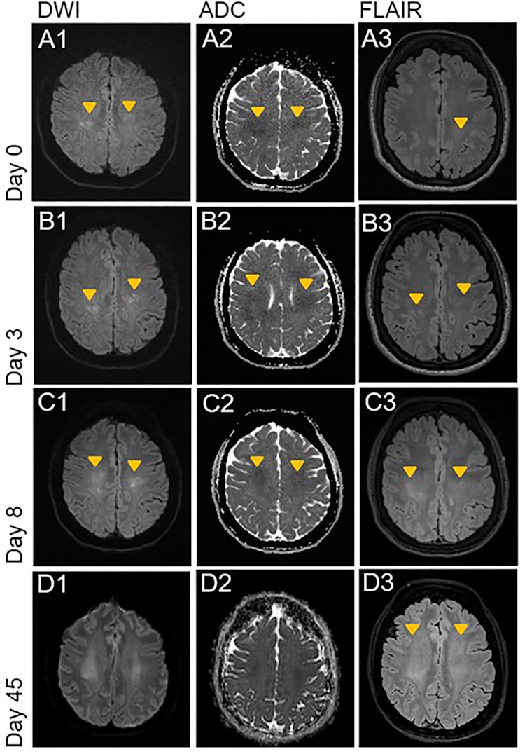 leukoencephalopathy