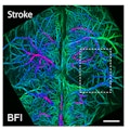 Stroke