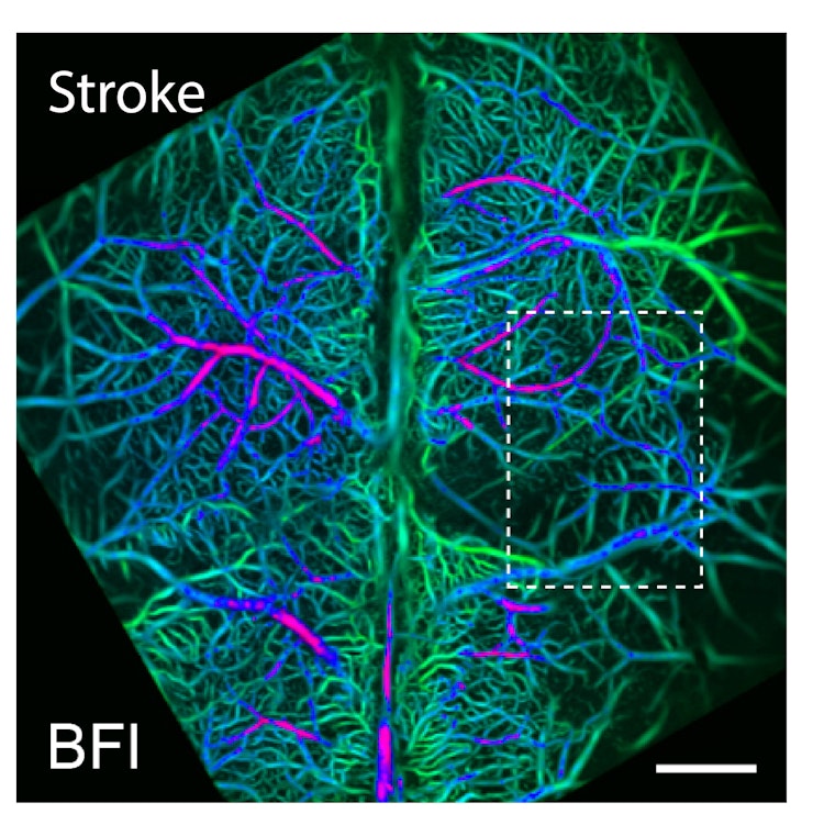 Stroke