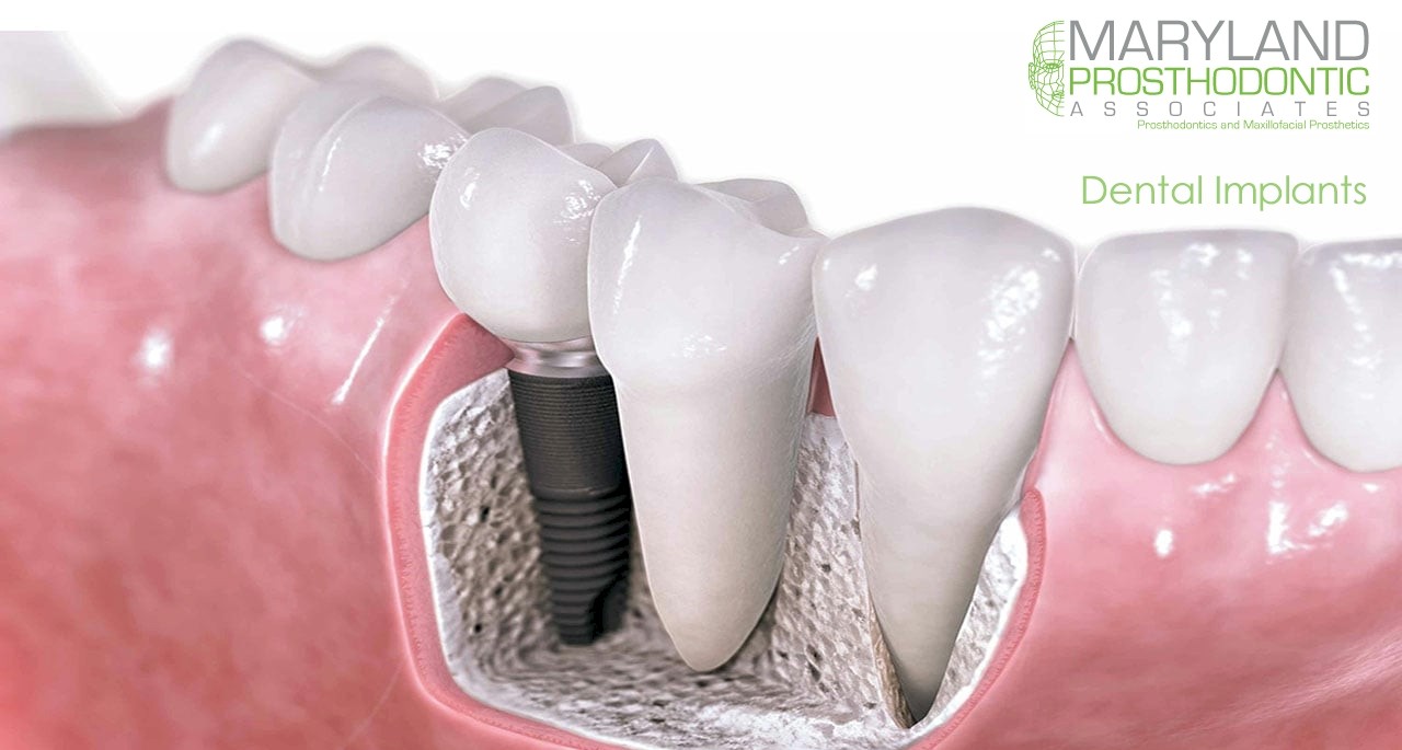 dental implant 3d model