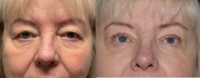 Blepharoplasty Before & After Gallery - Patient 523981 - Image 1
