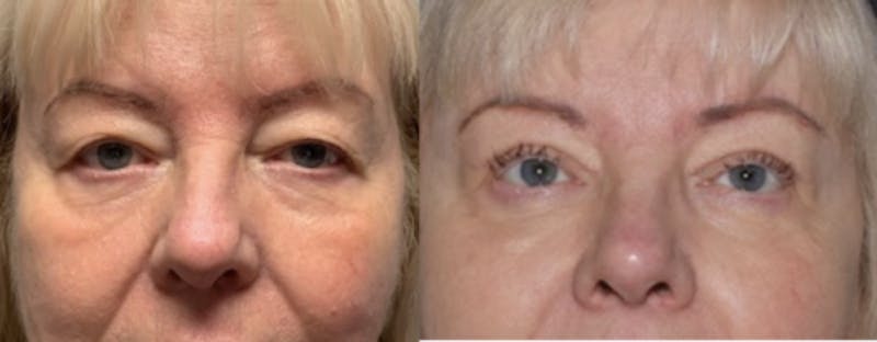 Blepharoplasty Before & After Gallery - Patient 523981 - Image 1