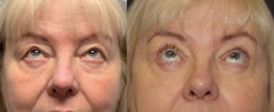 Blepharoplasty Before & After Gallery - Patient 523981 - Image 2