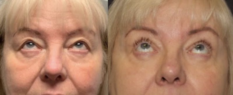 Blepharoplasty Before & After Gallery - Patient 523981 - Image 2