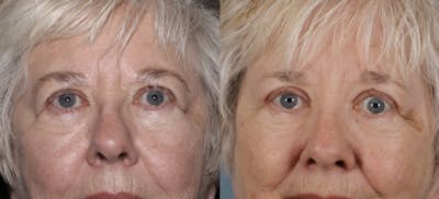 Blepharoplasty Before & After Gallery - Patient 228069 - Image 1