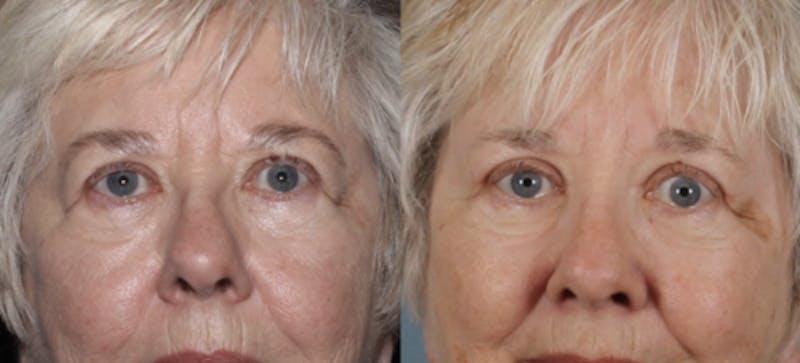 Blepharoplasty Before & After Gallery - Patient 228069 - Image 1