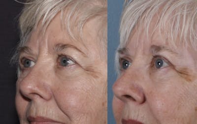 Blepharoplasty Before & After Gallery - Patient 228069 - Image 2
