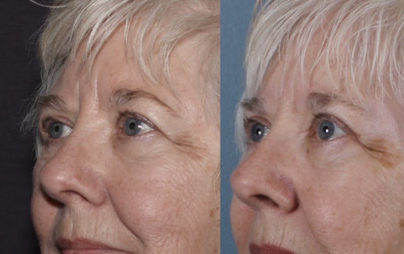 Blepharoplasty Before & After Gallery - Patient 228069 - Image 2
