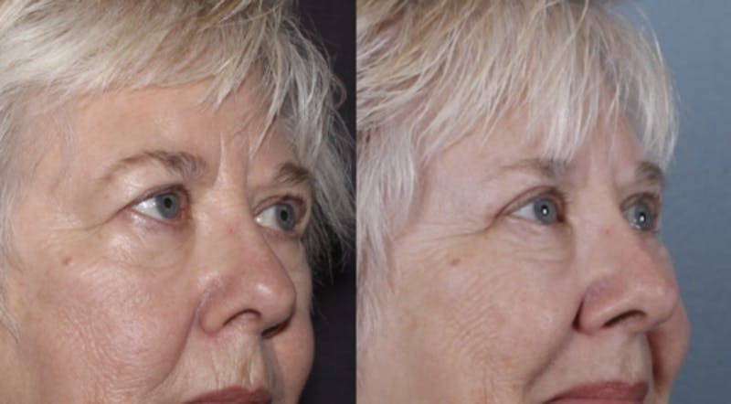 Blepharoplasty Before & After Gallery - Patient 228069 - Image 3