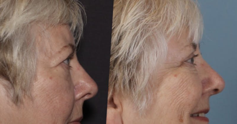 Blepharoplasty Before & After Gallery - Patient 228069 - Image 4