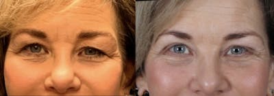 Blepharoplasty Before & After Gallery - Patient 105268 - Image 1
