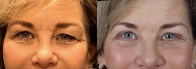 Blepharoplasty Before & After Gallery - Patient 105268 - Image 1