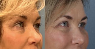 Blepharoplasty Before & After Gallery - Patient 105268 - Image 2