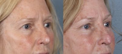 Blepharoplasty Before & After Gallery - Patient 256610 - Image 1