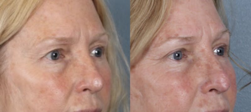 Blepharoplasty Before & After Gallery - Patient 256610 - Image 1