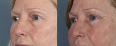 Blepharoplasty Before & After Gallery - Patient 256610 - Image 2