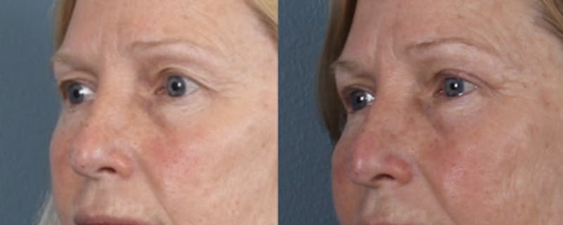Blepharoplasty Before & After Gallery - Patient 256610 - Image 2