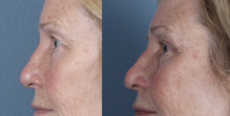 Blepharoplasty Before & After Gallery - Patient 256610 - Image 3