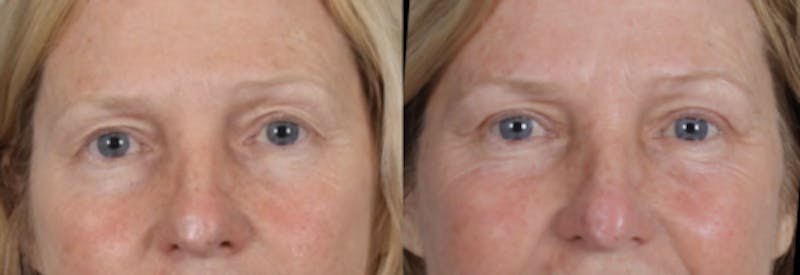 Blepharoplasty Before & After Gallery - Patient 256610 - Image 4