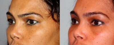 Blepharoplasty Before & After Gallery - Patient 411092 - Image 1