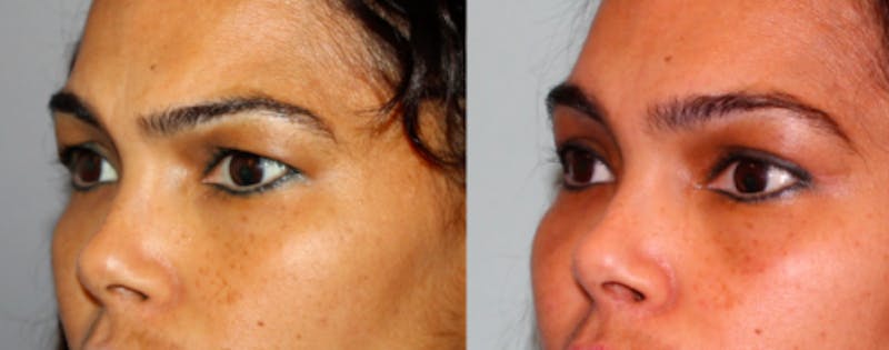 Blepharoplasty Before & After Gallery - Patient 411092 - Image 1