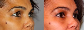 Blepharoplasty Before & After Gallery - Patient 411092 - Image 2