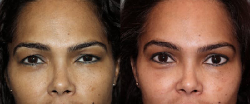 Blepharoplasty Before & After Gallery - Patient 411092 - Image 3