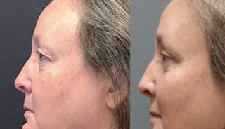 Blepharoplasty Before & After Gallery - Patient 388854 - Image 2