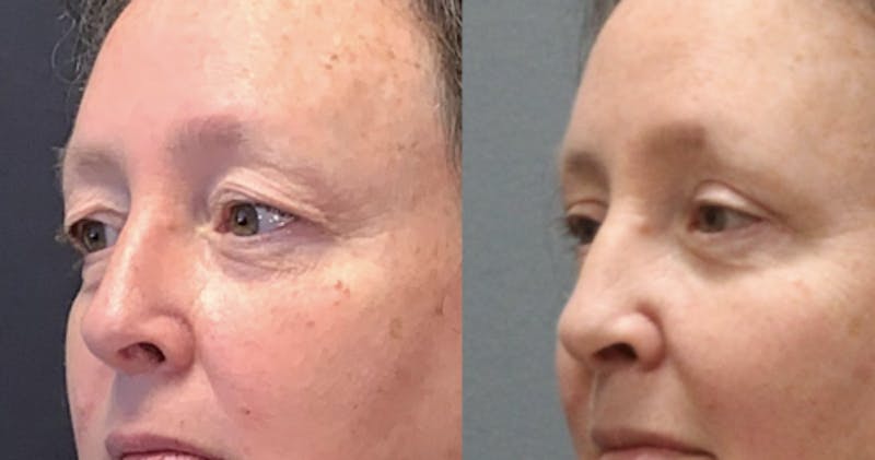 Blepharoplasty Before & After Gallery - Patient 388854 - Image 3