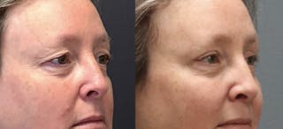 Blepharoplasty Before & After Gallery - Patient 388854 - Image 4