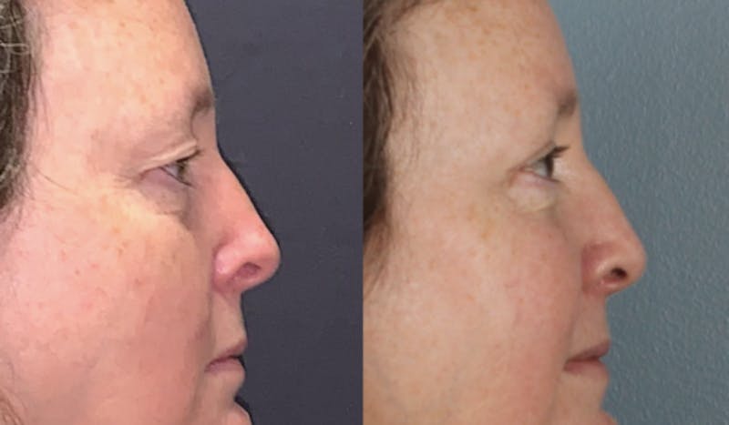 Blepharoplasty Before & After Gallery - Patient 388854 - Image 5