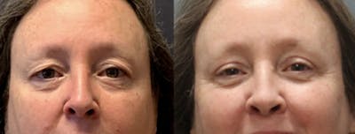 Blepharoplasty Before & After Gallery - Patient 388854 - Image 1