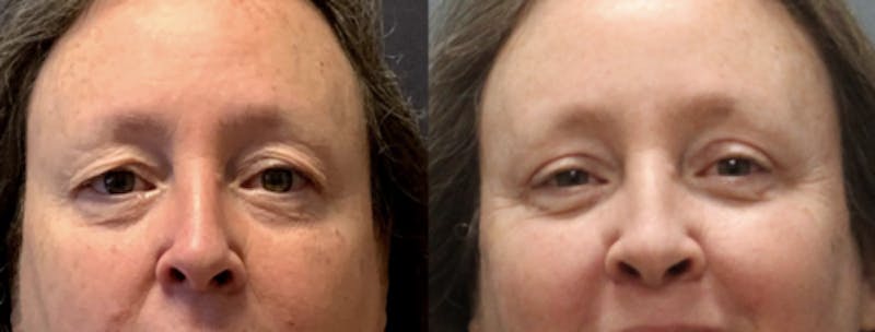 Blepharoplasty Before & After Gallery - Patient 388854 - Image 1