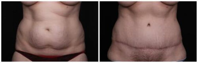 Abdominoplasty Before & After Gallery - Patient 256096 - Image 1