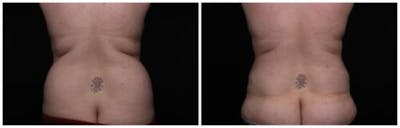 Abdominoplasty Before & After Gallery - Patient 256096 - Image 2