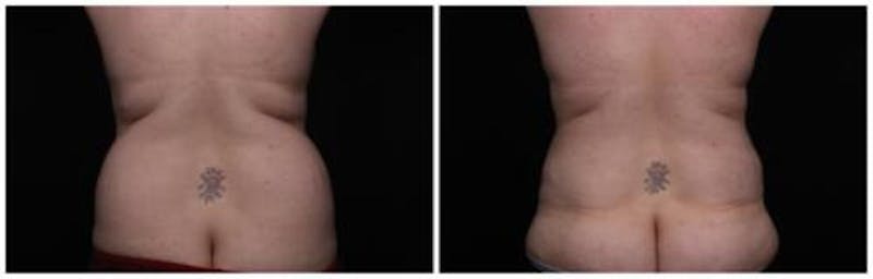 Abdominoplasty Before & After Gallery - Patient 256096 - Image 2