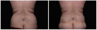 Abdominoplasty Before & After Gallery - Patient 256096 - Image 2